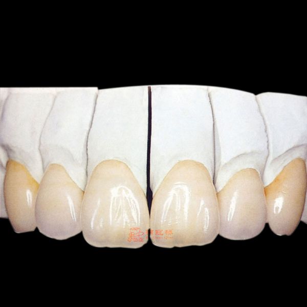 Pfm Porcelain Fused To Metal Crown Cobalt Chrome Alloy Metal Structure