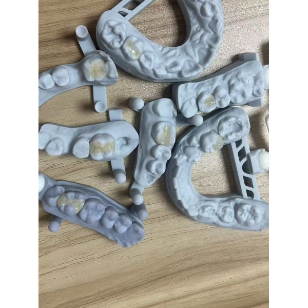 Emax Inlay and Onlay Dental Restoration with Natural Teeth Color, Minimal Preparation, and High Translucency