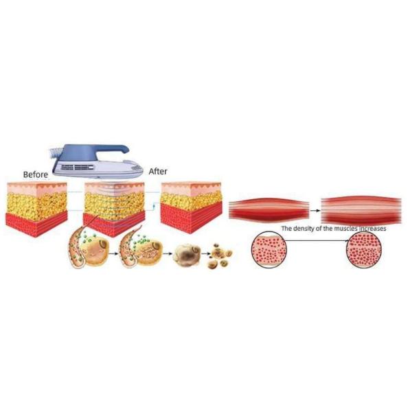 Машина мышцы Hiemt машины тела воздушного охлаждения Emslim ваяя красивая