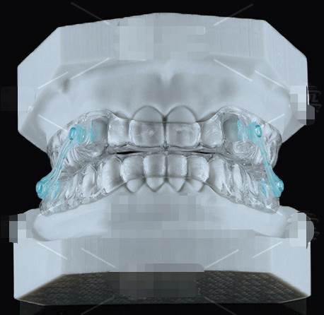 Transparent Erkodent Silensor Orthodontics Appliance Anti Snoring Mouthpiece