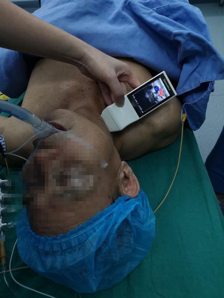 Wireless Linear Probe High Frequency Probe Special Tool for Visual Puncture Guidance Integrated Handheld Ultrasound Scanner