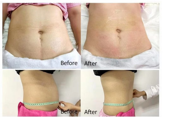 9 In1 Weight Loss Cool Tech Body Slimming Fat Freezing 360Cryolipolysis Machine