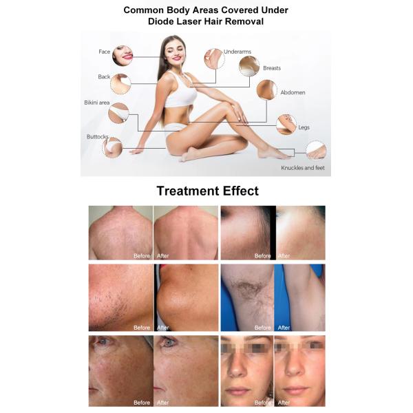 New Technology Hair Removal laser Machine 500-1600W 808NM Diode Laser OEM Lazer Hair Remover Beauty Equipment Factory