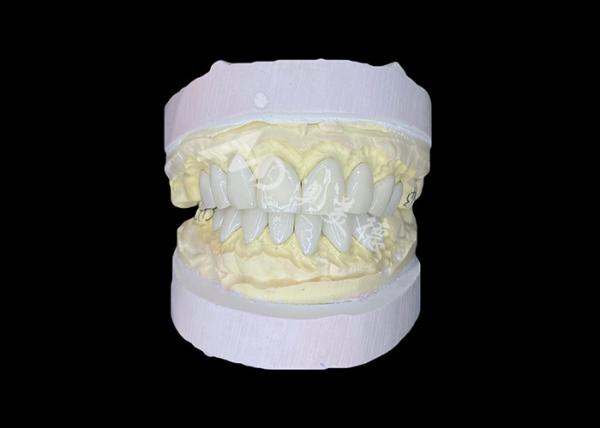 Les placages IPS e.max fabriqués avec précision pour des transformations de sourire inégalées offrant une durabilité et une esthétique exceptionnelles et un ajustement parfait pour chaque patient