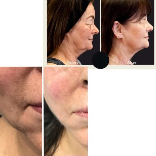 Skin Tightening Fat Removal EVLT Machine 15W 20W Diode Laser Therapy Device