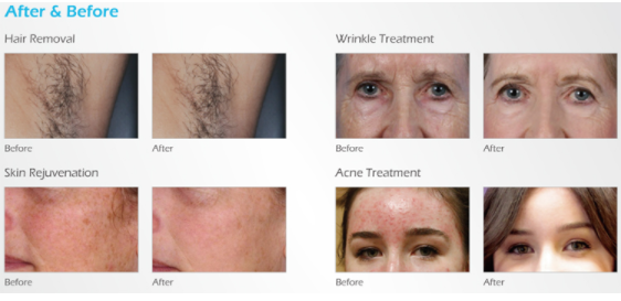 OPT 5 In 1 Hair Removal Powerful Laser IPL Machines / IPL OPT SHR For Hair And Skin Rejuvenation