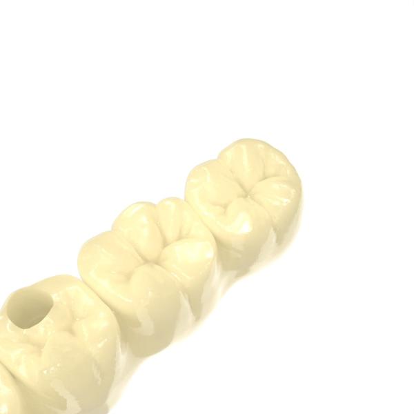 Biocompatible Material Photosensitive Resin 3d Printing For Temporary Crown And Bridge