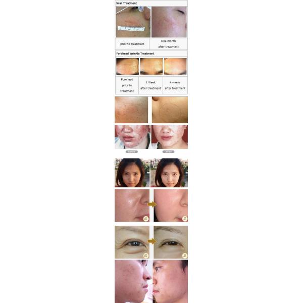 Experience the Benefits of Dns Derma Roller and Meso Roller Biog for Dark Circles