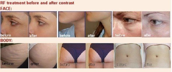 RF Cryolipolysis уменьшая Vela RF вакуума кавитации машины био формировать 40 k