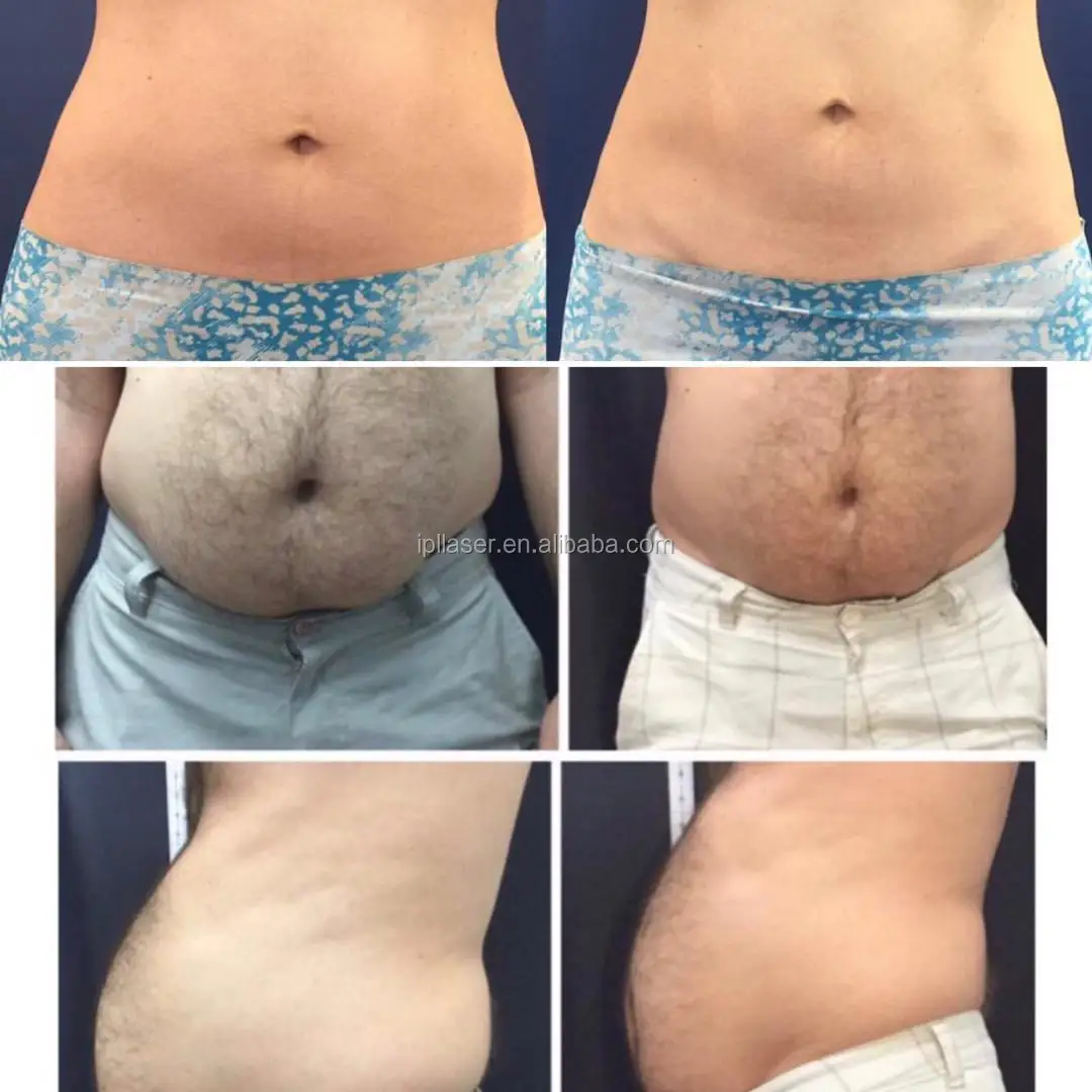 1060nm diode laser sculpsure body contouring fat freezing slimming system for fat loss