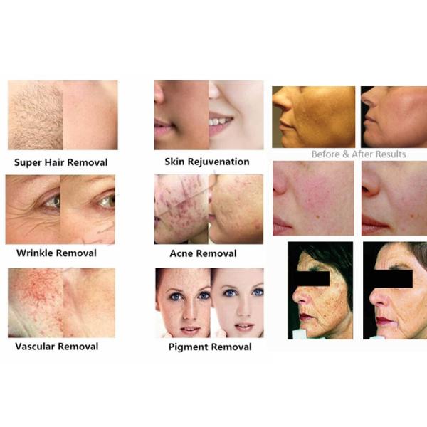 Skin Rejuvenation 360 Magneto Optic Hair Removal Machine 10.4 Inch Touch Screen