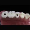 Customized Implant Teeth Bridge Implanting Guide Look Like Natural Teeth Restore Oral Health, Function and Appearance