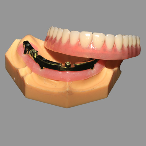 Lmplant Dental Laboratory | Full Acrylic Denture All On X Dental Lmplants AOX Class 4 With Locator Attachment