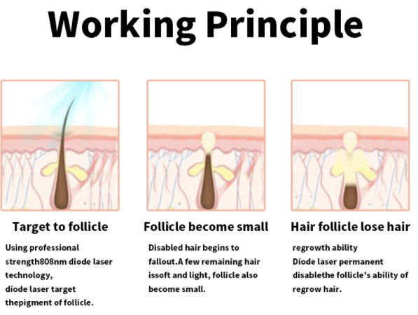RF Elight Laser Hair Removal 2 Handpiece 640nm 560nm Skin Rejuvenation Machine