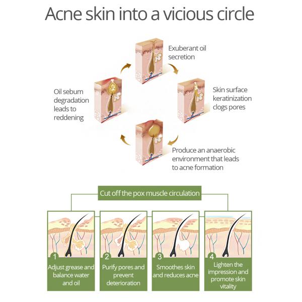 Нежная сливк 30g обработки угорь заботы кожи для кожи угорь прональной чувствительной