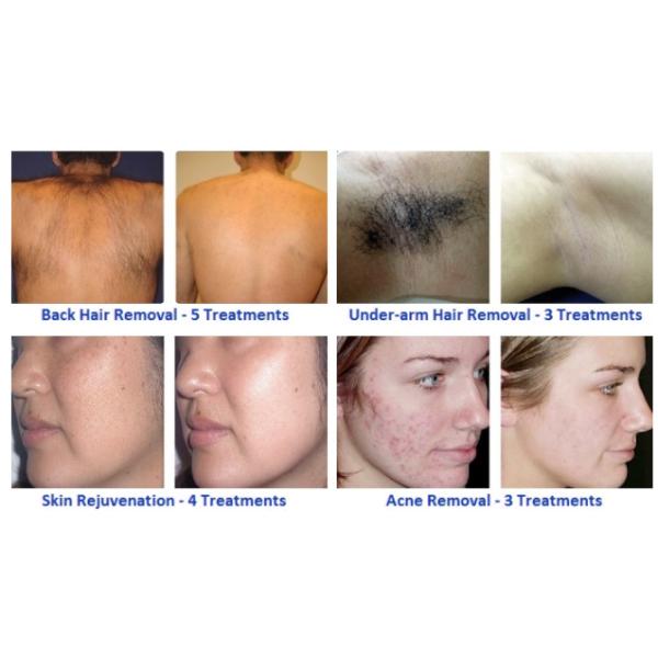 AC110V Freckle Removal Machine Ipl Laser Hair Removal Device