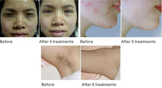 КЭ ОПТ КОРМОВОЕ ФКА ЛасерТелл оборудования красоты удаления волос лазера одиночных/Мульти-ИМПа ульс СХР людей