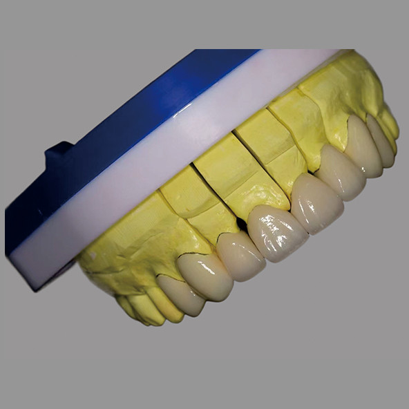 High Translucency IPS E Max Veneers Stains Resistant Biocompatible