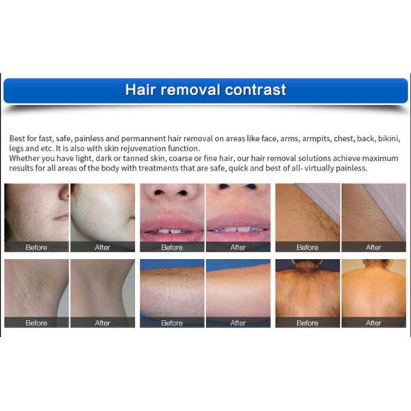 удаление волос лазера диода 1500W 808nm, безболезненный постоянный лазер Alexandrite 755nm