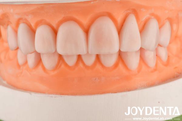 Custom Made IPS Porcelain Emax Veneers Dental Restorations Chipping Resistant