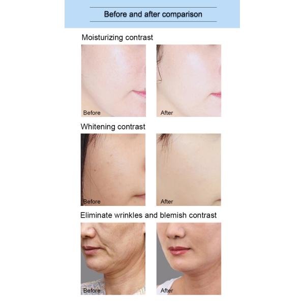 8 in 1 multifunctional water peel microdermabrasion facial machine for acne treatment