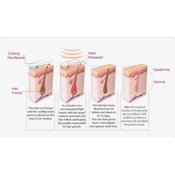 808nm 810nm Mobile Laser Hair Removal Machine Permanent 600w 10 Bars