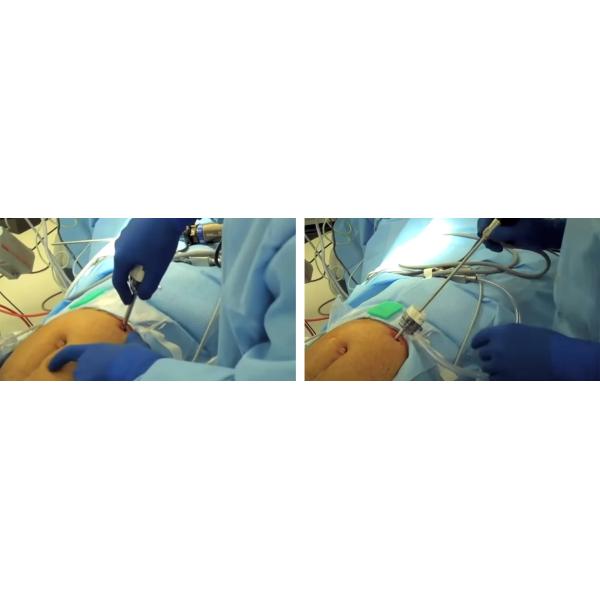 Лапароскоп Хирургический одноразовый безлопастный трокар для проколки живота