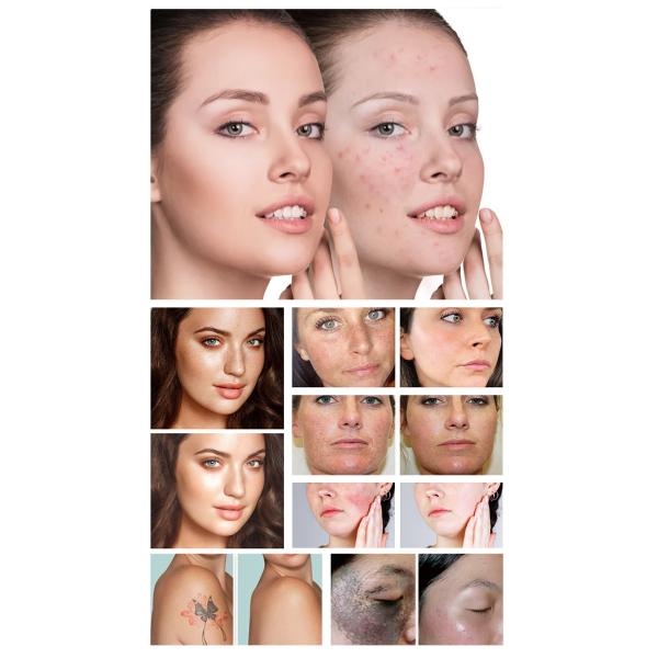 Supplier Dual Wavelength Laser Hair Removal Machine For Remove Tattoos And Pigment