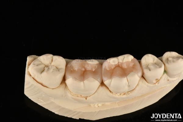 Natural Polymerized Porcelain Dental Inlay Onlay For Tooth Restoration