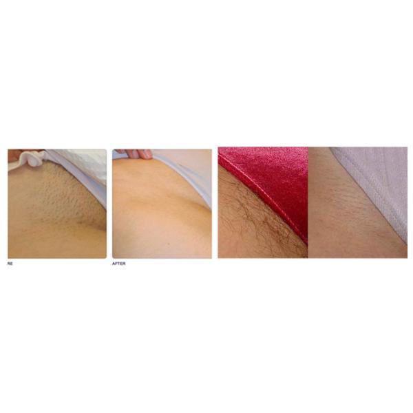 Alexandrite Laser Beauty Equipment 808nm , Tuv Fda Ipl Hair Removal Machine