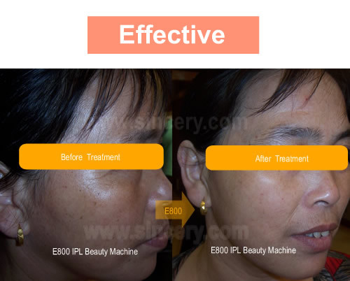 Оборудование удаления волос лазера ИПЛ профессиональное