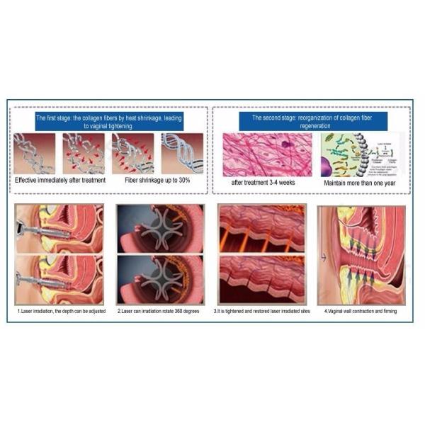 оборудование лазера СО2 воздушного охлаждения 10.64um частичное для удаления шрама