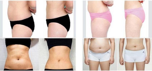 (Hot in USA) Revolutionary Stubborn Fat Killer ultrashape hifu slimming machine korea