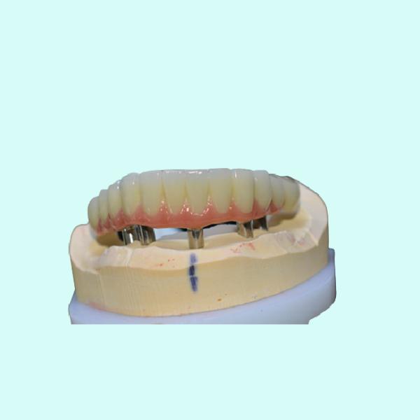 Легкая очищая крона зубного имплантата удобная отсутствие ощущения инородного тела