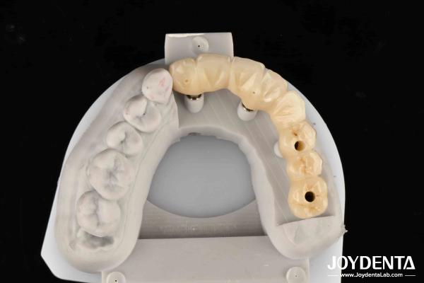 Close Friends Of Bones Foundation Of Beauty Zirconia Implants Aesthetically Supreme Choice With No Risk Of Metal Allergy