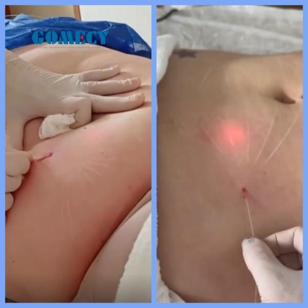 Remove Red Blood Effectively with Endolift Laser Machine 980nm 1470nm 635nm Wavelengths and 0-999s Pulse Duration