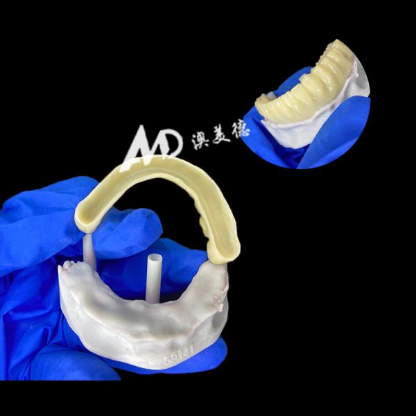 PMMA Provisional Implant Bridge with Hollow Inside for Stability and Natural Healing, High-precision CAD/CAM Fabrication, Biocompatible PMMA Material
