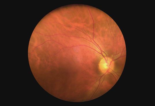 Handheld портативная офтальмическая камера Fundus цифров системы с высокой телемедициной объектива определения 1080P доступной