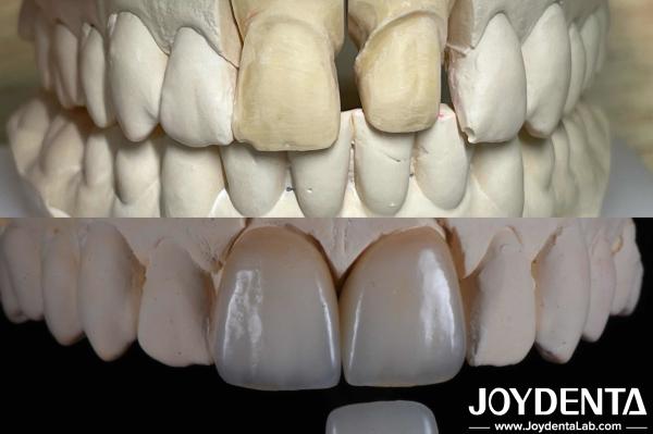 Veneurs dentaires à surface lisse pour les dents tortueuses, veneurs de porcelaine cosmétique sur mesure