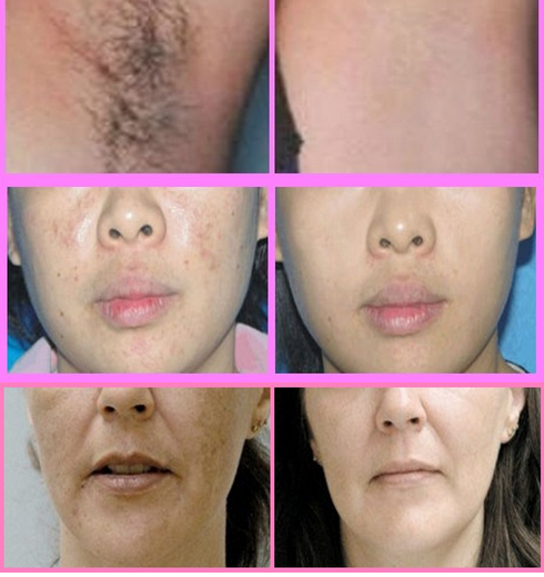 SHR Painless Hair Removal IPL Laser Machine , Yag Laser Tattoo Removal Machine