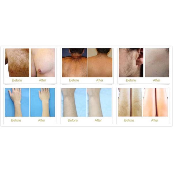 2000W Elight Laser Hair Removal AC110V For Clinic Beauty Spa