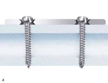 Запирающая пластинка 3,5 Humerus Lcp дистальная для Intraarticular трещиноватостей