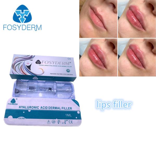 Заполнитель Fosyderm 1ml Derm стороны и губ извлекая морщинки