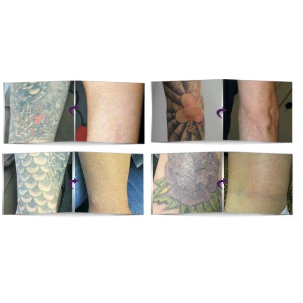 Portable Q - Switched Tattoo Laser Removal Equipment With Adjustable Treatment Probes