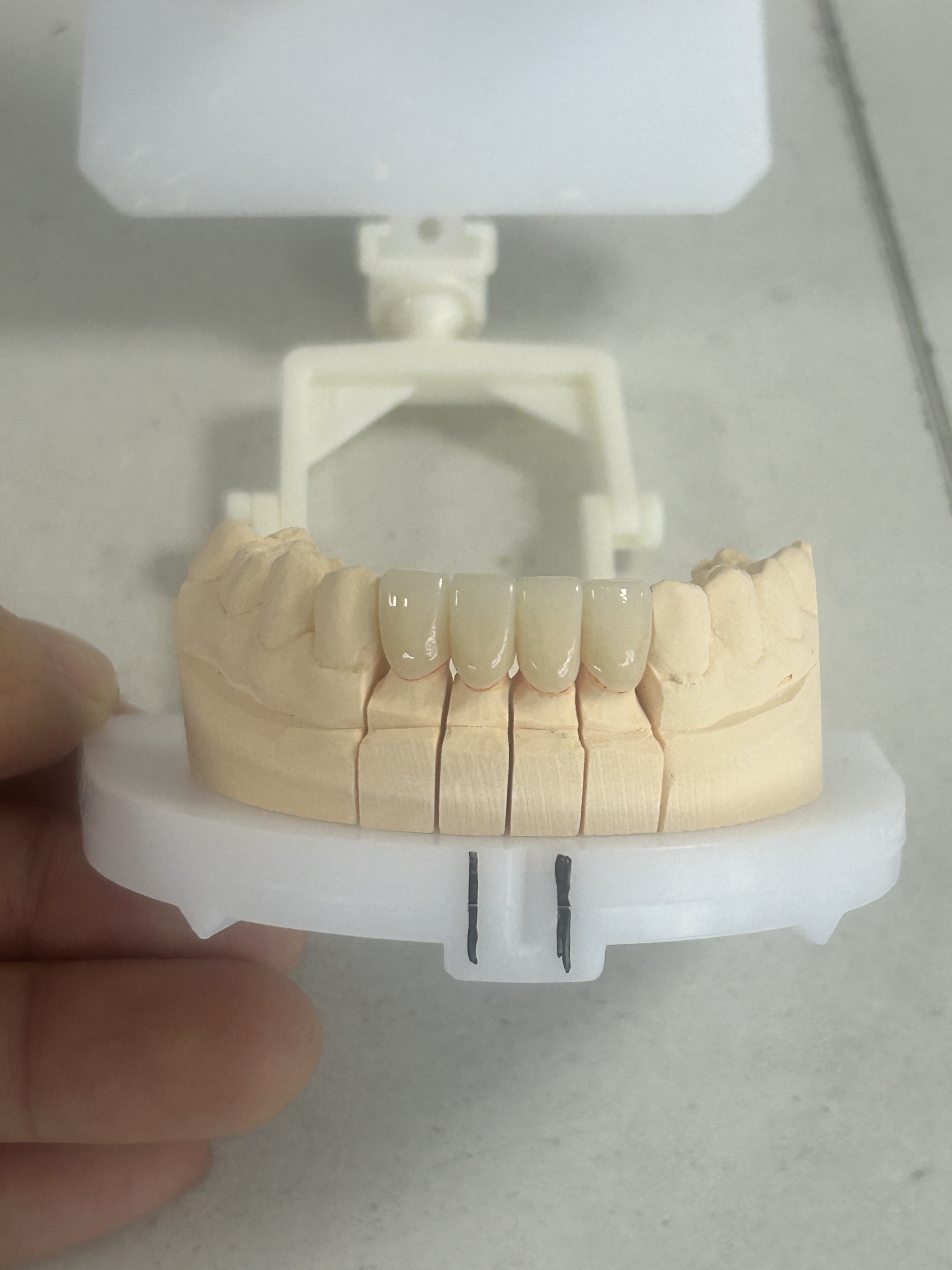 Custom Full Zirconia Crowns with CAD/CAM Digital Production for Natural