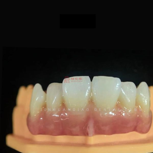Natural Translucent Zirconia Restorations Custom Designed For Anterior Teeth