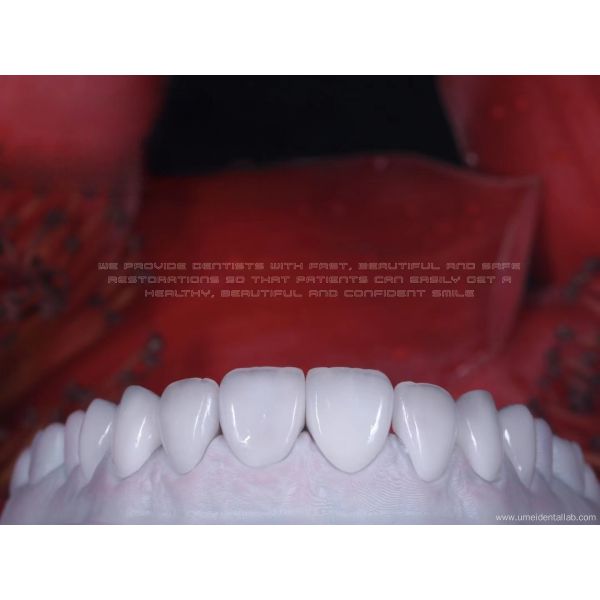 Zirconia Ceramic Veneer Natural White