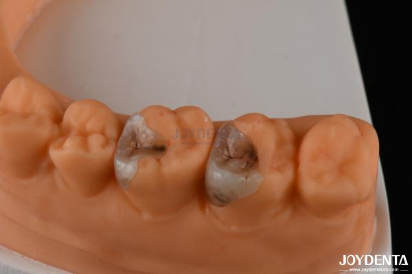 Custom Compound Inlay Onlay For Minimally Invasive Dental Restoration