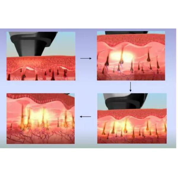 Painless 808nm Diode Laser Hair Removal Machine Vertical Type For Any Skin Color