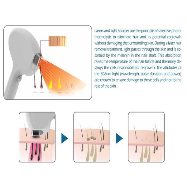 Германия запирает 10000000 снятую машину лазера диода удаления 808nm волос